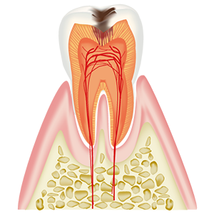 C2　象牙質に達した虫歯