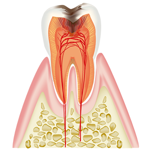 C3　神経 （歯髄）に達した虫歯