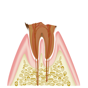 C4　歯質が失われた虫歯