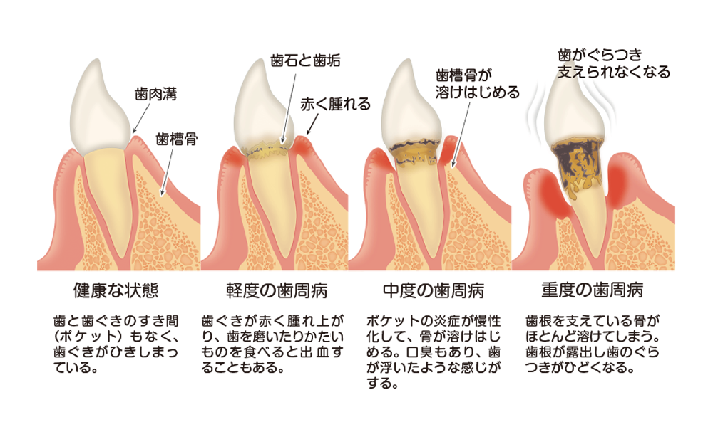 歯周病の進行